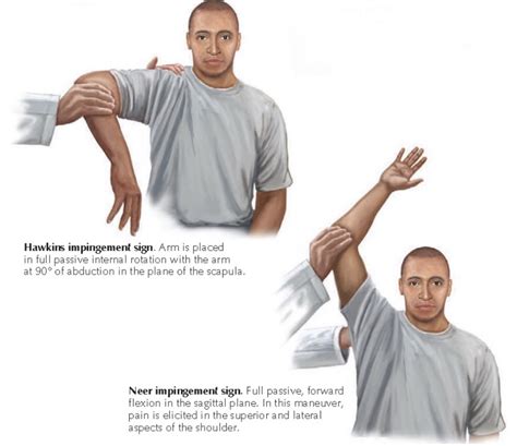 supraspinatus tear characteristics neer hawkins test|hawkins tear sensitivity.